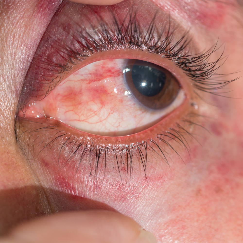 concussion patient with red eye