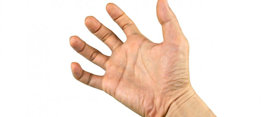 Patient with dystonia