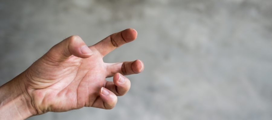 The hand of a dystonia patient suffering from muscle spasms